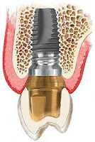 Todo lo que debes saber sobre los implantes dentales 11