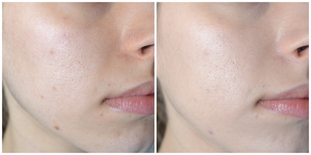 before and after, less redness and pigmentation, brightening, but not much coverage