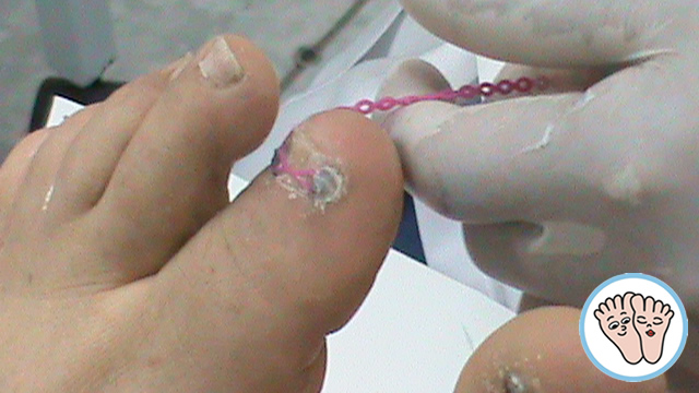 El tratamiento del hongo de las uñas de los pie dirigirse a que médico