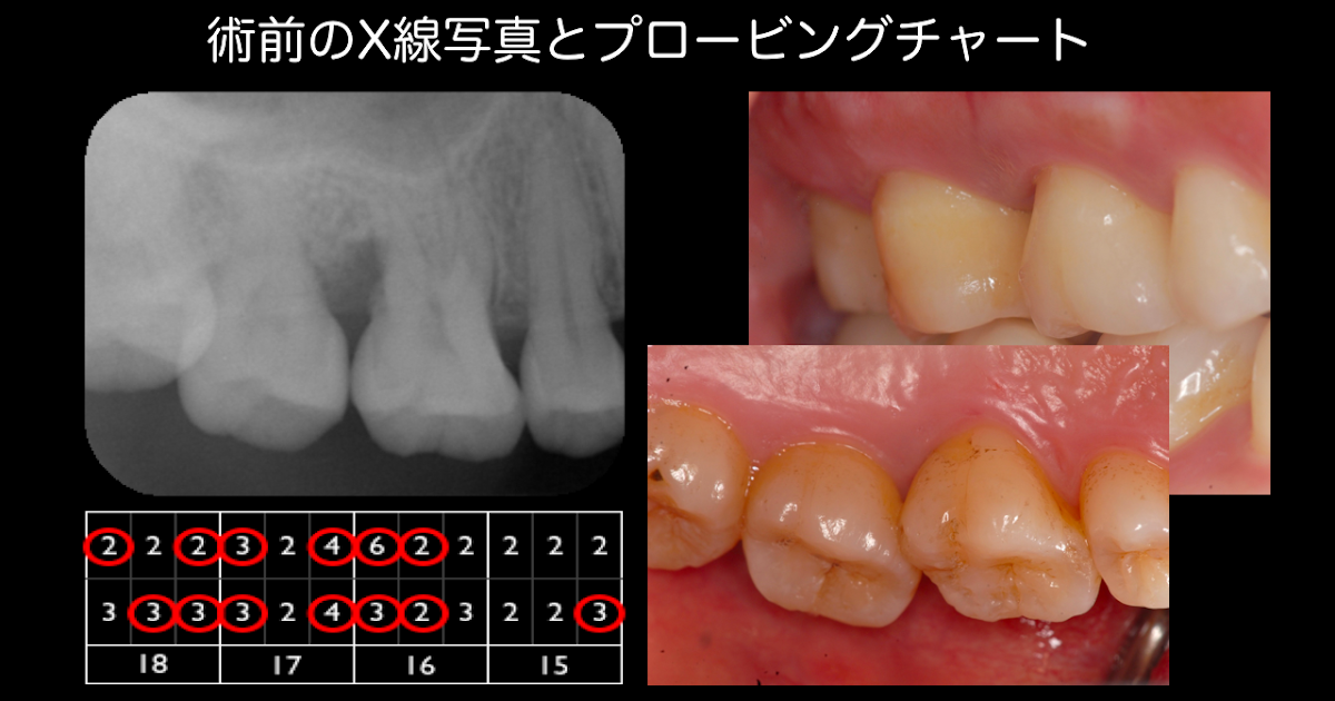 Japanese Dental Hygienist naomi Scaling in periodontal pocket at
