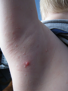 mollescum spots under arm, childhood zits like red angry spts with white center 