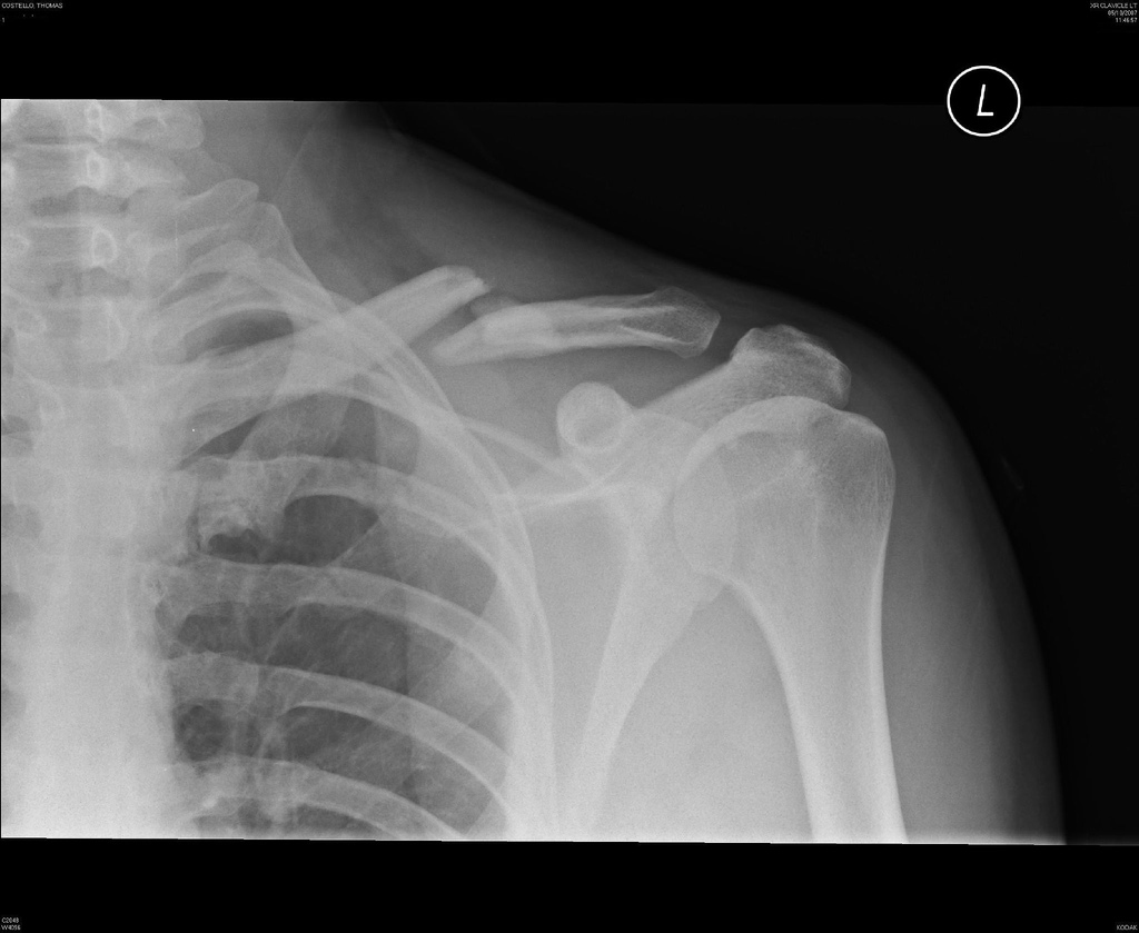 Fractured Bones One of the most fragile bones in the body, but less fragile than the -4.bp.blogspot.com
