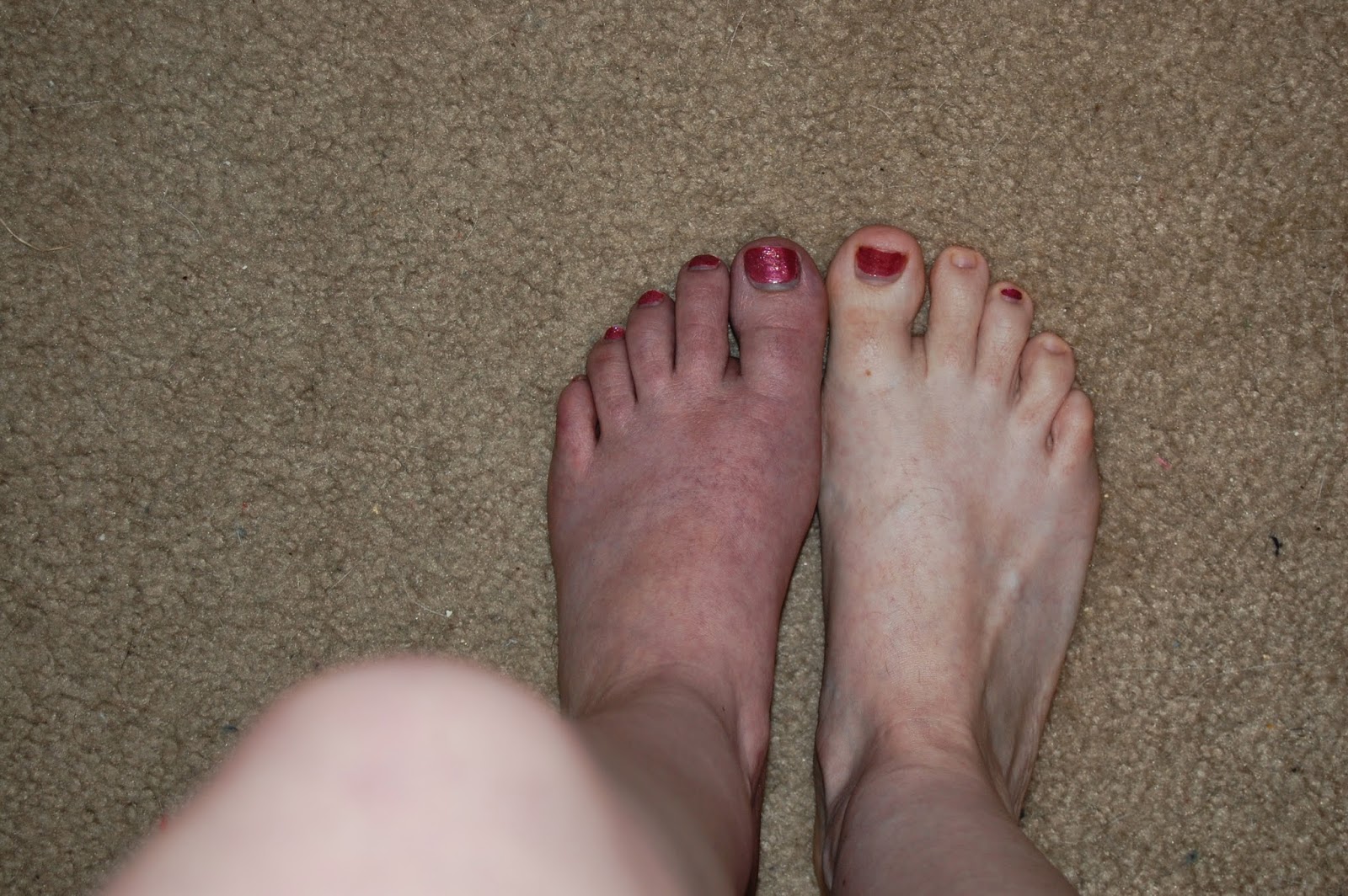 Foot and Ankle Problems By Dr. Richard Blake Soft Tissue Injury