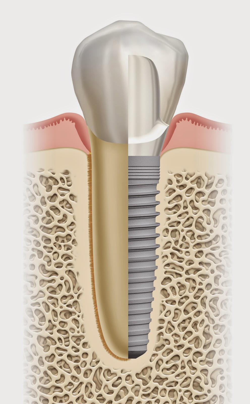 Átila bucomaxilo: Implantes Dentários