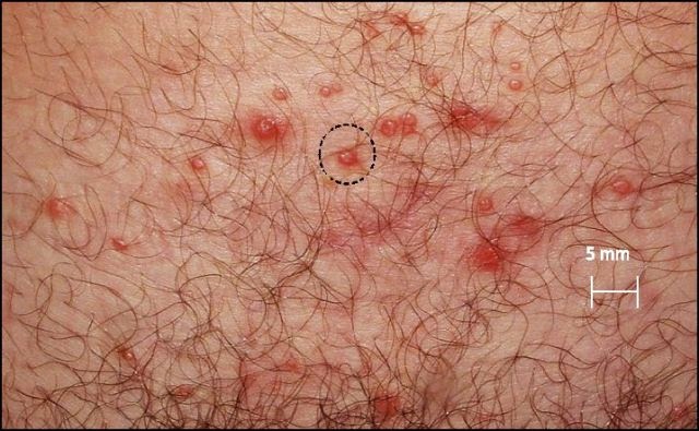 Can you get genital herpes from oral sex images 963