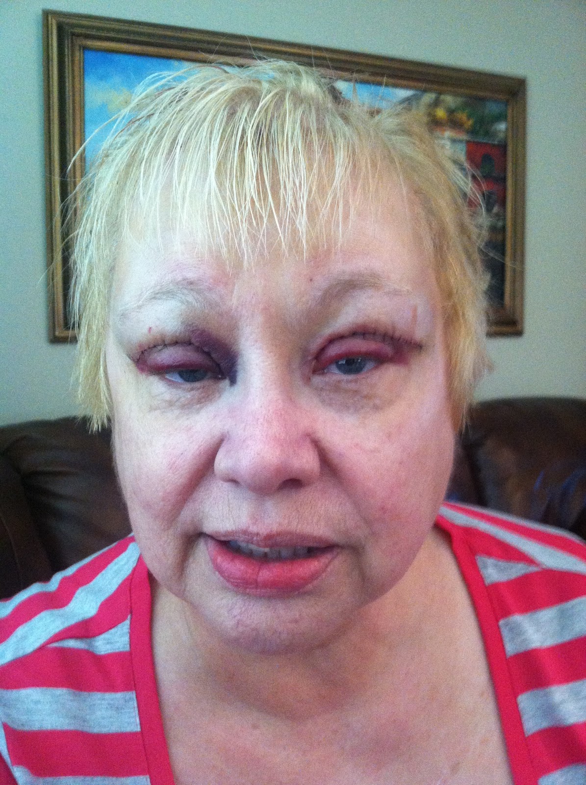 Plastic surgery nose miami 2014, blepharoplasty thailand, cost breast