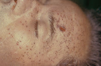 Orifice d'entrée d'un tir à bout portant avec des tatouages tout autour Mort - Cadavre- Blessure par arme à feu - Orifice d'entrée d'un tir à bout portant avec des tatouages tout autour