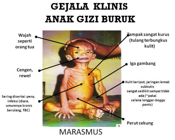 KEKURANGAN ENERGI PROTEIN KEKURANGAN ENERGI PROTEIN
