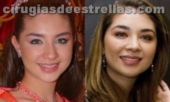 Desgraciado la operación plástica del pecho antes y después