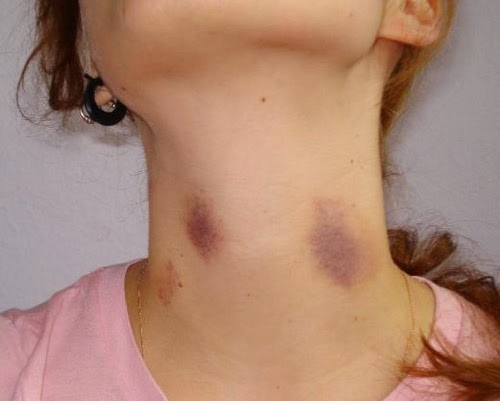 Rid how hickey get to of an How to