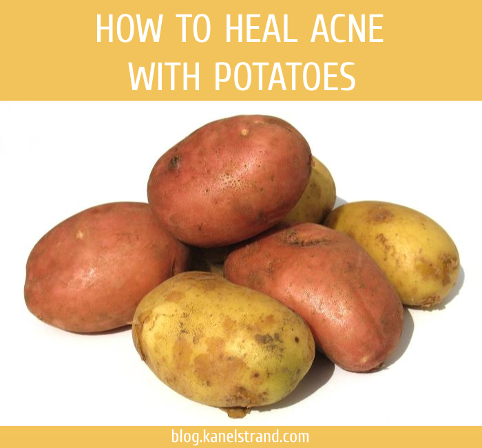 Kanelstrand Heal Acne and Pimples With Potatoes