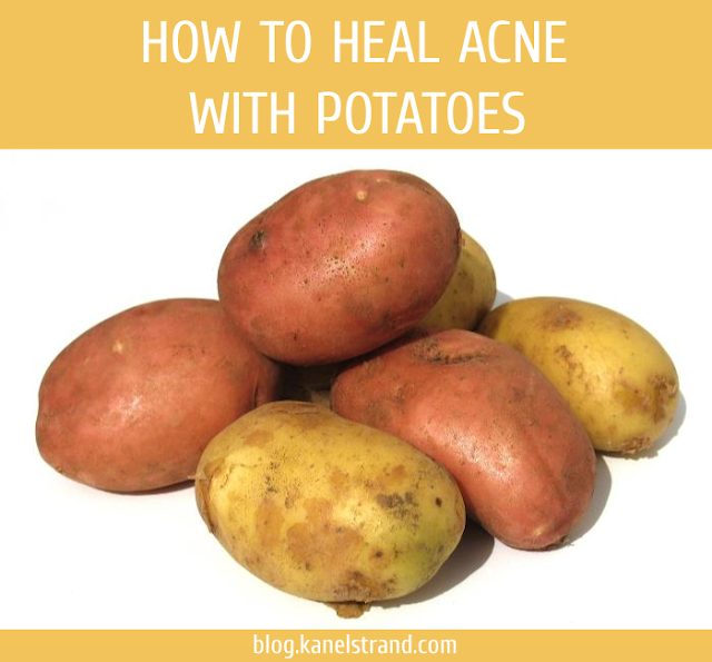 How to Heal Acne With Potatoes