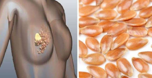 How to Prevent and Cure Breast Cancer With One Natural Ingredient Breast Cancer - Prevent and Cure