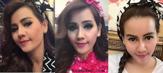 Berikut Foto Nita Talia Setelah Operasi Plastik