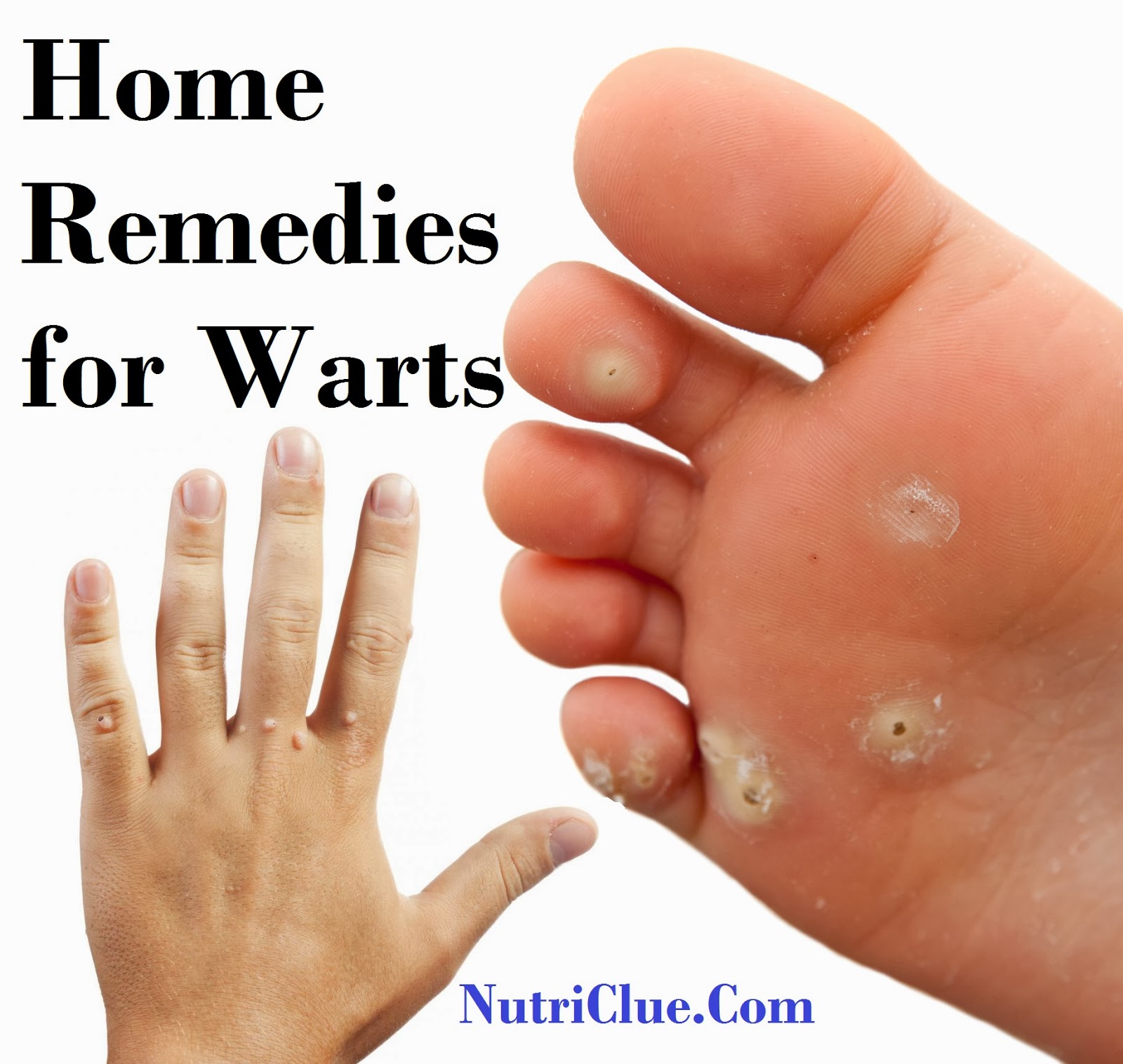 Wart treatment at home, comfort inner soles, arch support for flat feet
