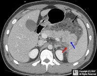 Acute Pancreatic Attack