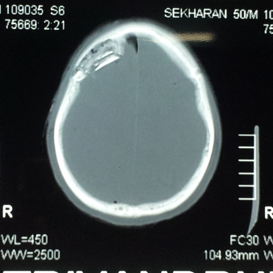 General Surgery Clinics A Surgeon's Blog Depressed Fracture Skull