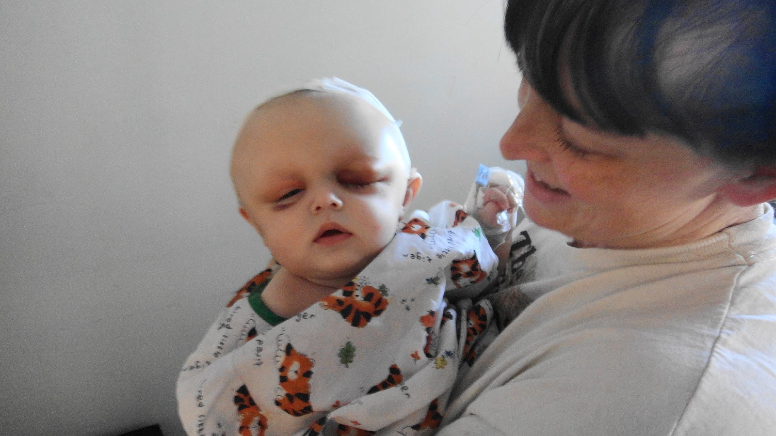 FATTKAW: Metopic Ridge and it is gone...