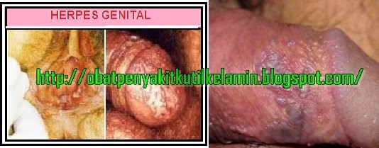 Penyakit Herpes Penyakit Herpes