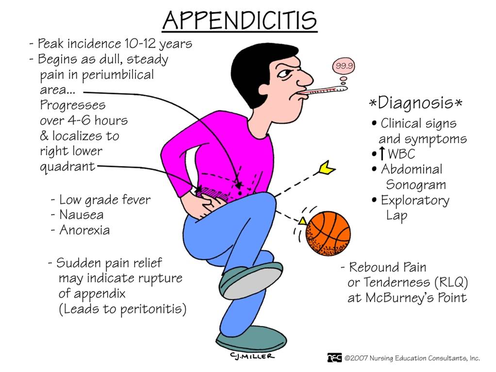 Appendicitis-ABC Medicine