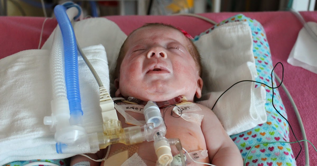 Surgery Tracheostomy & GTube Dear Annie