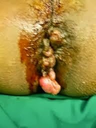 Image obat hemmoroid parah