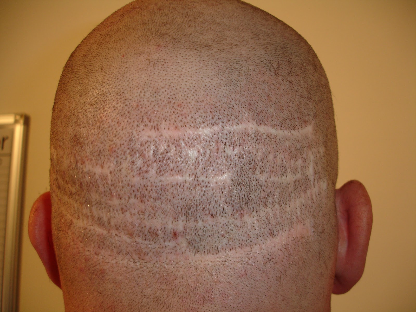 Hair+Transplant+Scarring+before.JPG