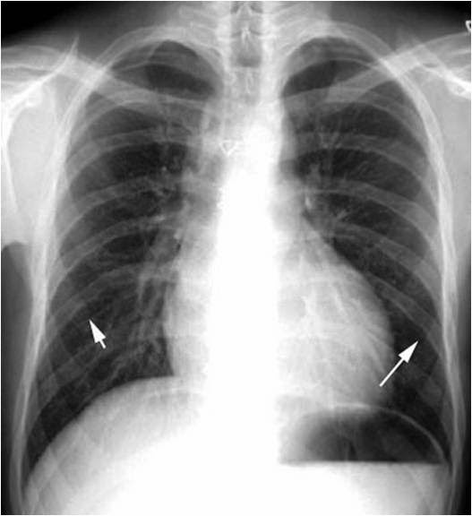 RADIOLOGY IMAGE SPOTTERS Rib notching Coarctation of aorta