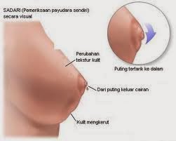 Pengobatan Ampuh Kanker Payudara Pengobatan Ampuh Kanker Payudara