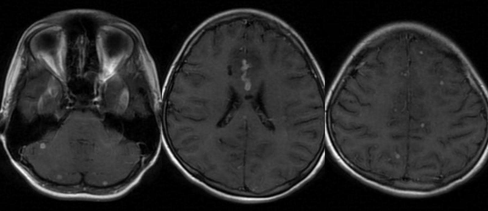 Tb Brain