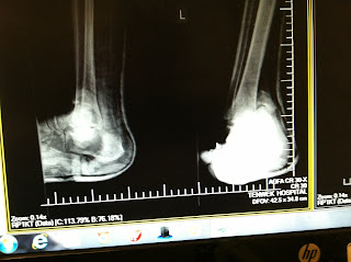 Case #3: 65 year Male, Ankle Fracture-Dislocation