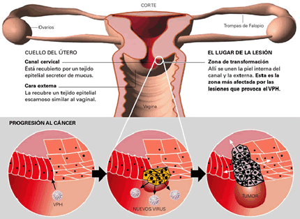 leucemia leucemia
