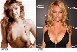Pamela Anderson Breast Implants Before & After