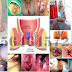 OBAT HEMOROID (Wasir Stadiun 4) Pasti Manjur thumbnail
