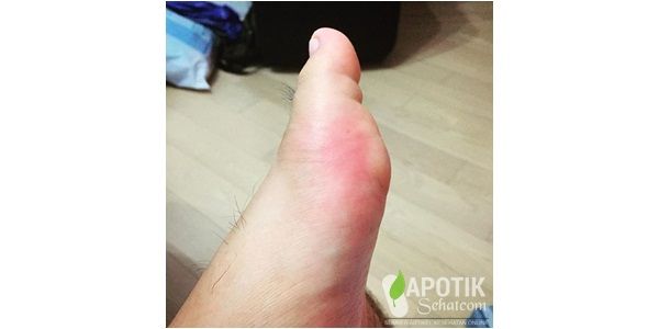 Obat Asam Urat Di Apotik Obat Asam Urat Di Apotik