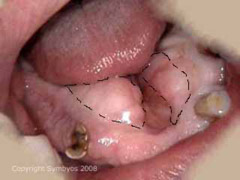 alveoloplasty oral surgery dental india dental ahmedabad umiya