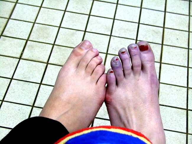 Finger+Ulcers+From+Raynauds kb jpeg tongue showing the presence of raynaud s disease stock image ...