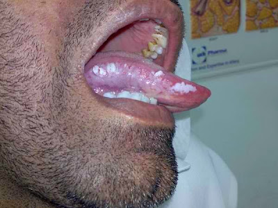 White Patches Inside Your Mouth