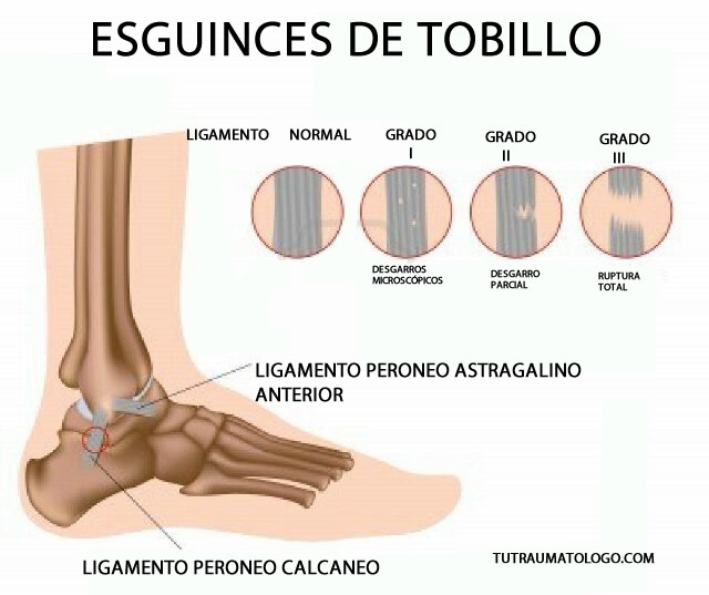 LESIONES EN EL LIGAMENTO lesiones en el ligamento: