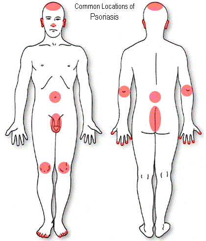 Is psoriasis contagious?