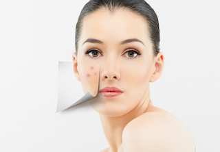 Why use witch hazel for acne? Why use witch hazel for acne?