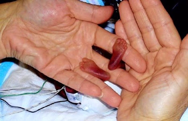 extraordinarios casos de supervivencia de bebes recién nacidos