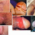 Harga Obat Anti Sipilis Alami thumbnail
