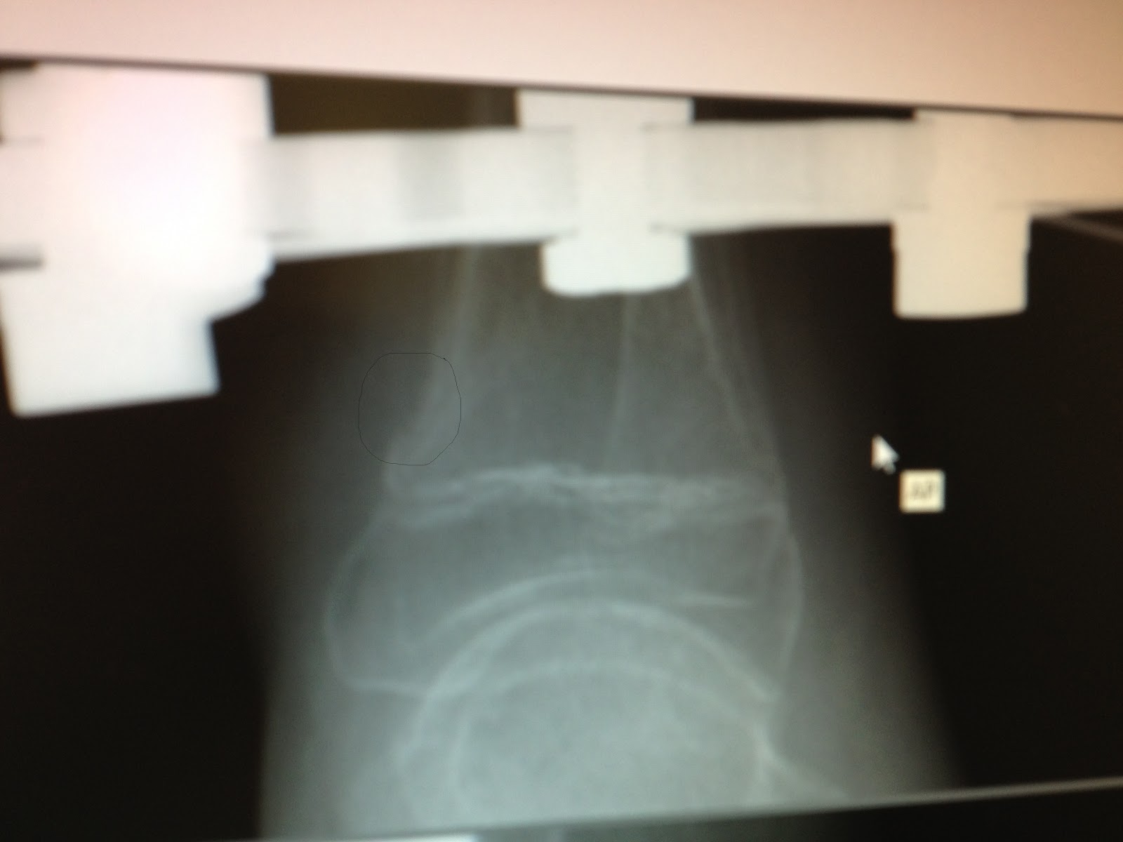 fibular hemimelia leg lengthening Whew! A "dent" vs. a break