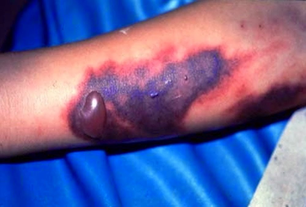 Ebola Virus Symptoms Ebola Virus Symptoms