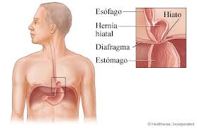 hernia de hiato