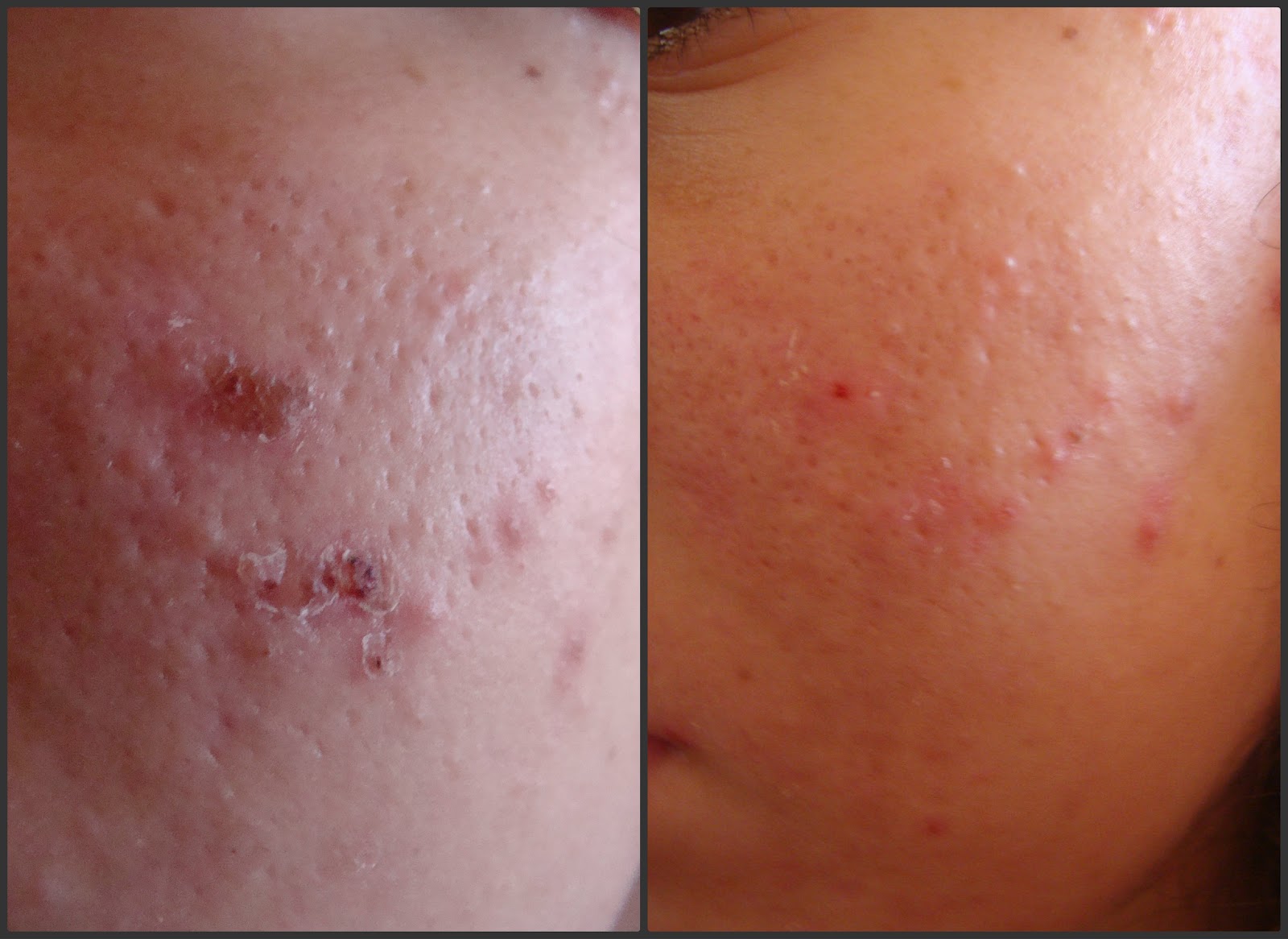 Cicaplast Baume B5 Review Coffees, Desserts and Life