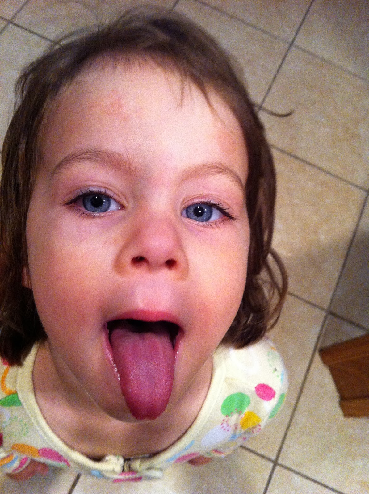 Hives in the Kitchen Band Aid Adhesive and Allergy