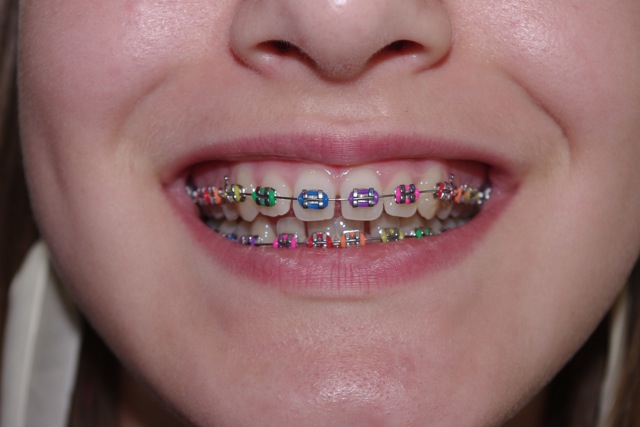 Braces Rainbow