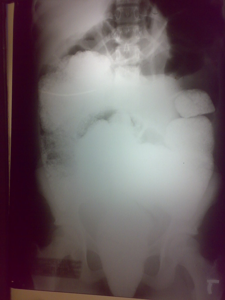 pica x ray